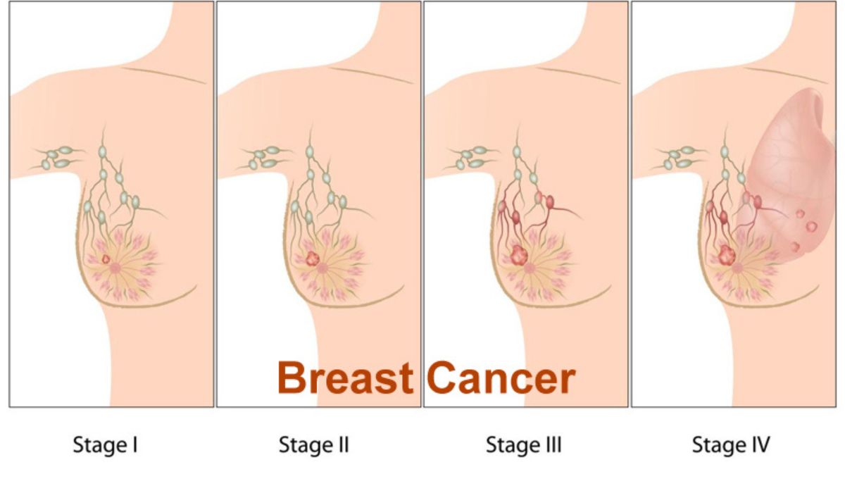 breast cancer के बाद प्राकृतिक सुंदरता लौटाने वाली सर्जरी तकनीकें – मेदांता हॉस्पिटल डॉ. आदित्य अग्रवाल